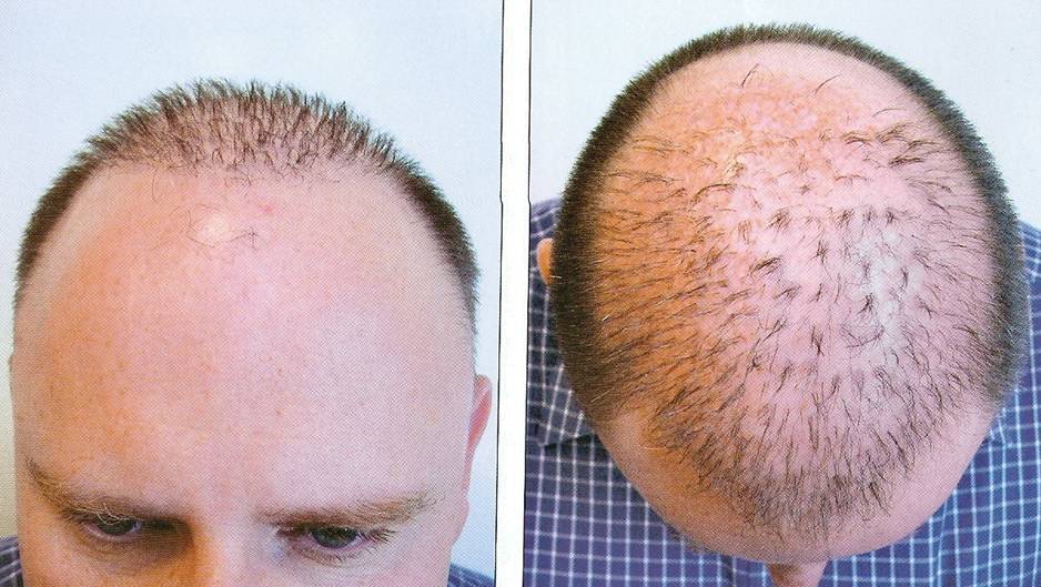 natural way to regrow the hair